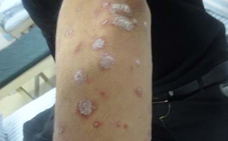 牛皮癬靜止期癥狀,牛皮癬癥狀表現(xiàn)