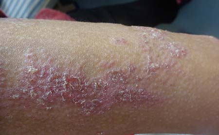 秋冬銀屑病復發(fā),怎樣避免秋冬銀屑病復發(fā)