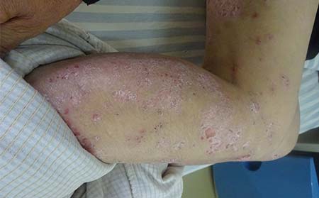 兒童銀屑病癥狀,兒童銀屑病癥狀特征