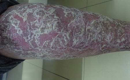 紅皮型牛皮癬癥狀,紅皮型牛皮癬早期癥狀