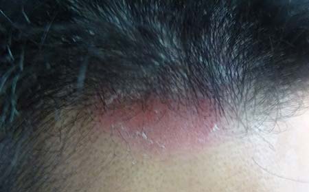 兒童頭部銀屑病癥狀,頭部銀屑病癥狀