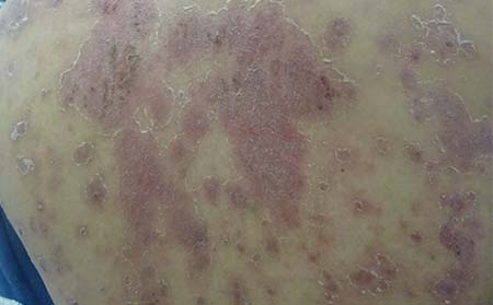 牛皮癬癥狀,牛皮癬典型癥狀表現