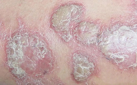 銀屑病鱗屑特點