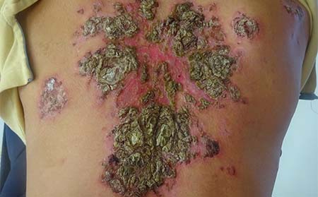 膿皰型銀屑病癥狀,怎樣判斷得膿皰型銀屑病