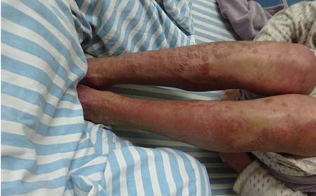 尋常型銀屑病癥狀,尋常型銀屑病臨床表現