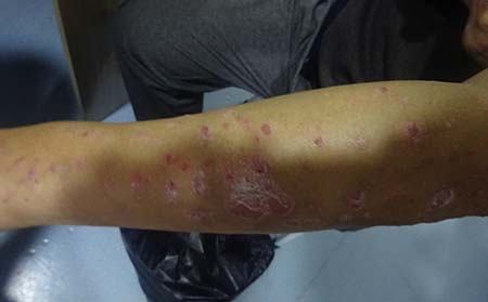 銀屑病癥狀表現(xiàn),怎樣看是銀屑病癥狀