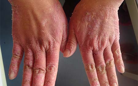 銀屑病甲癥狀,銀屑病甲圖片