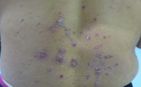 牛皮癬癥狀表現,得牛皮癬有什么癥狀