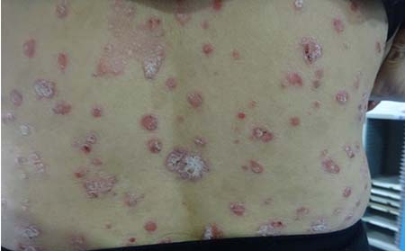 尋常型銀屑病癥狀,點滴狀銀屑病癥狀