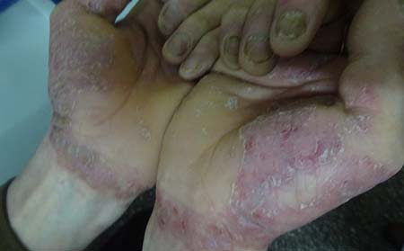 牛皮癬誘發(fā)因素,牛皮癬同形反應(yīng)