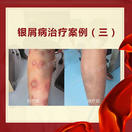 銀屑病公益會診