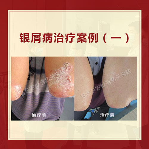 銀屑病聯(lián)合的會診
