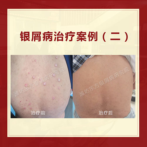 銀屑病綜合會診