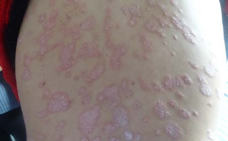 牛皮癬癥狀,牛皮癬發作時癥狀