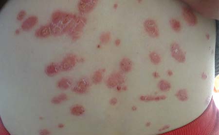 點狀銀屑病癥狀,點關(guān)銀屑病癥狀圖片