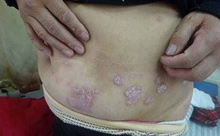 牛皮癬初期癥狀,初期牛皮癬癥狀表現(xiàn)