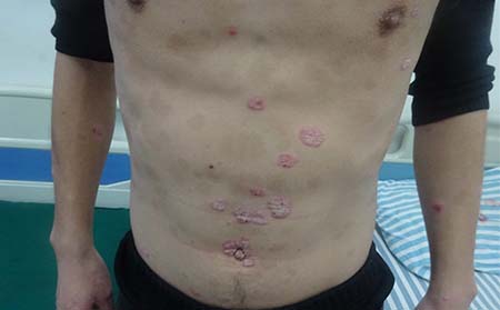 腹部牛皮癬癥狀,腹部長牛皮癬什么癥狀