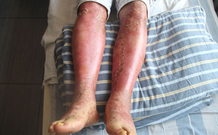 腳部牛皮癬癥狀,腳上長牛皮癬什么樣