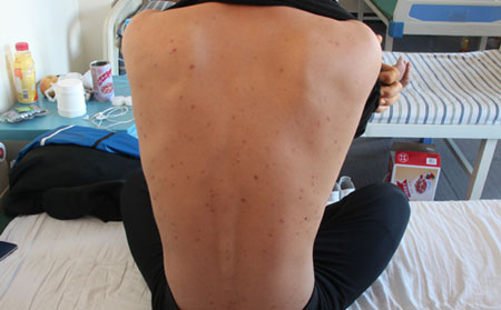 堅(jiān)持跑步一年銀屑病好了