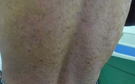 牛皮癬初期癥狀,牛皮癬癥狀初期表現