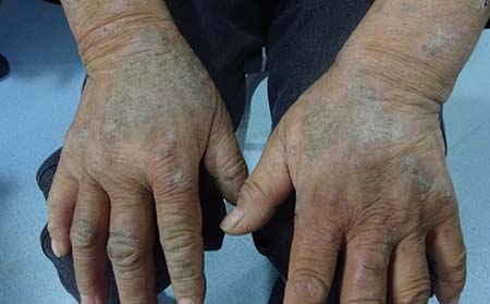 關(guān)節(jié)型牛皮癬癥狀,關(guān)節(jié)型牛皮癬什么樣