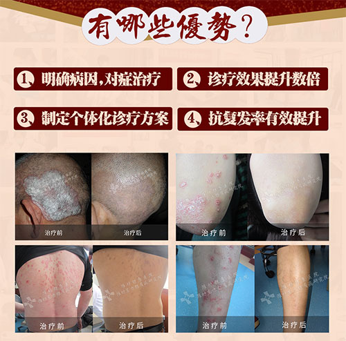銀屑病聯合會診優勢