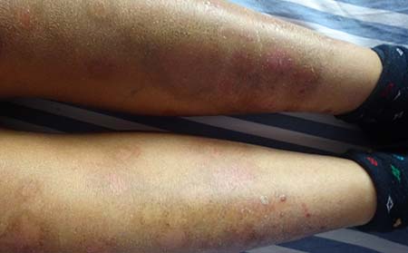 牛皮頑癬,牛皮頑癬怎樣治