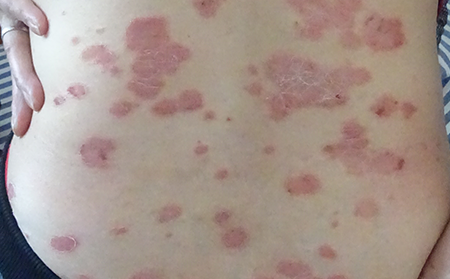 斑塊狀牛皮膚癬