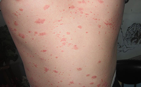 點滴狀牛皮膚癬