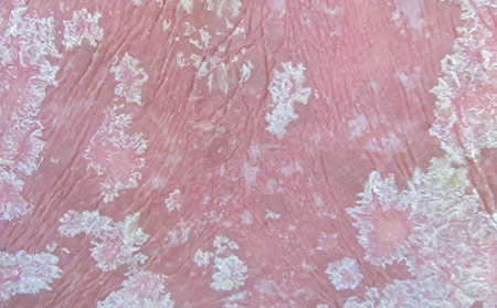 膿皰型牛皮膚癬