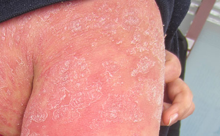 紅皮病型牛皮膚癬