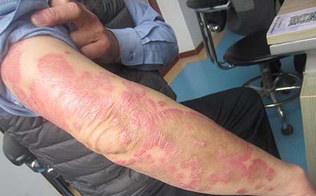 牛皮膚癬關節炎