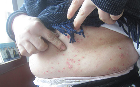 牛皮膚癬是怎么得的_牛皮膚癬的種類圖片癥狀