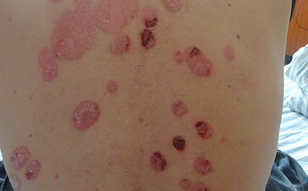 牛皮膚癬初期_尋常型牛皮膚癬癥狀圖片