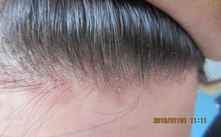 牛皮膚癬圖片_頭皮牛皮膚癬癥狀圖片