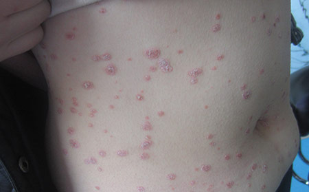 牛皮膚癬圖片大全_點(diǎn)滴狀牛皮膚癬癥狀圖片