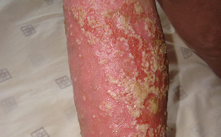 牛皮膚癬的癥狀_膿皰型牛皮膚癬癥狀圖片