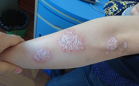 什么是牛皮膚癬斑塊