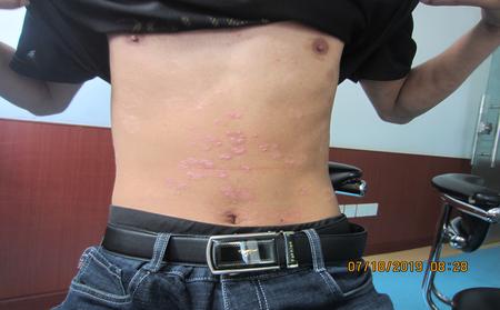 什么是牛皮膚癬