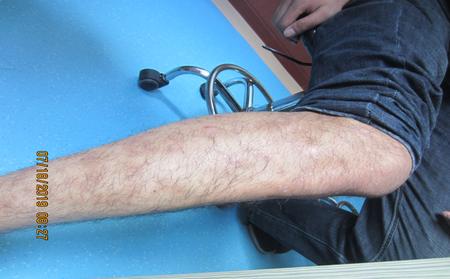 牛皮膚癬圖片大全