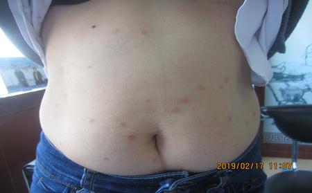 牛皮膚癬的初期癥狀有哪些