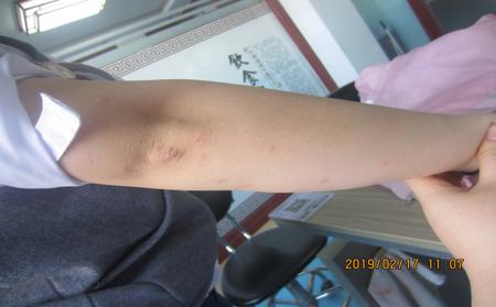 牛皮膚癬是怎么得的