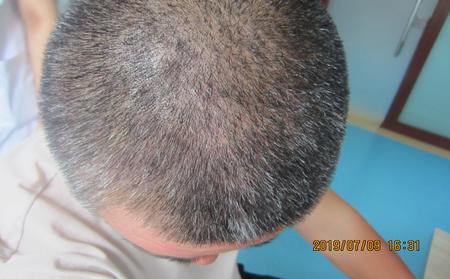 早期牛皮膚癬的癥狀是什么