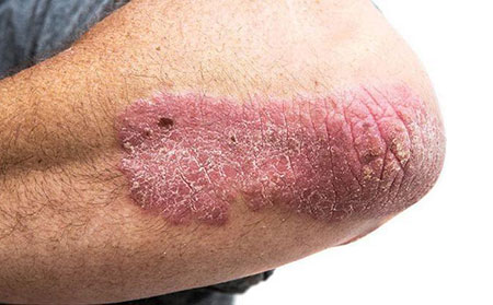 早期牛皮膚癬圖片初期是什么