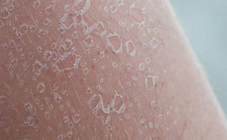 牛皮膚癬怎么引起的