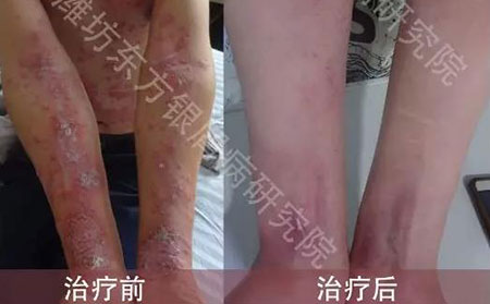 濰坊東方醫院青少年患者臨床康復對比圖