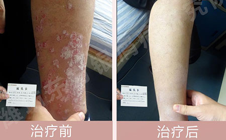 濰坊東方醫院患者腿部康復對比圖