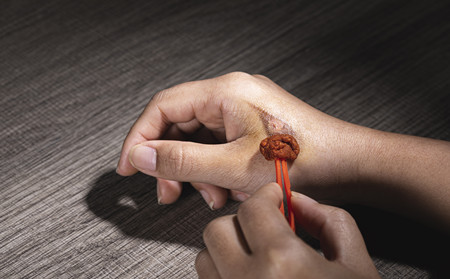 碘伏能治銀屑病嗎,治銀屑病能用碘伏嗎