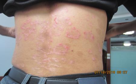 牛皮頑癬早期圖片癥狀