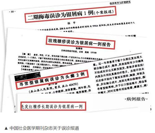 銀屑病誤診報(bào)道